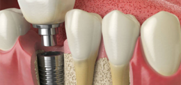 HIGH QUALITY IMPLANTS IN THE UP DENTAL CLINIC