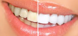 SPECIAL OFFER – UP DENTAL CLINIC OFFERS TOOTH WHITENING AT SPECIAL PRICE FROM VALENTINES DAY UNTIL THE END OF THE MONTH<