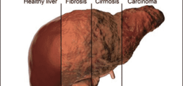FREE SCREENING for Liver Fibrosis will re-start on Tuesday 2nd June 2020